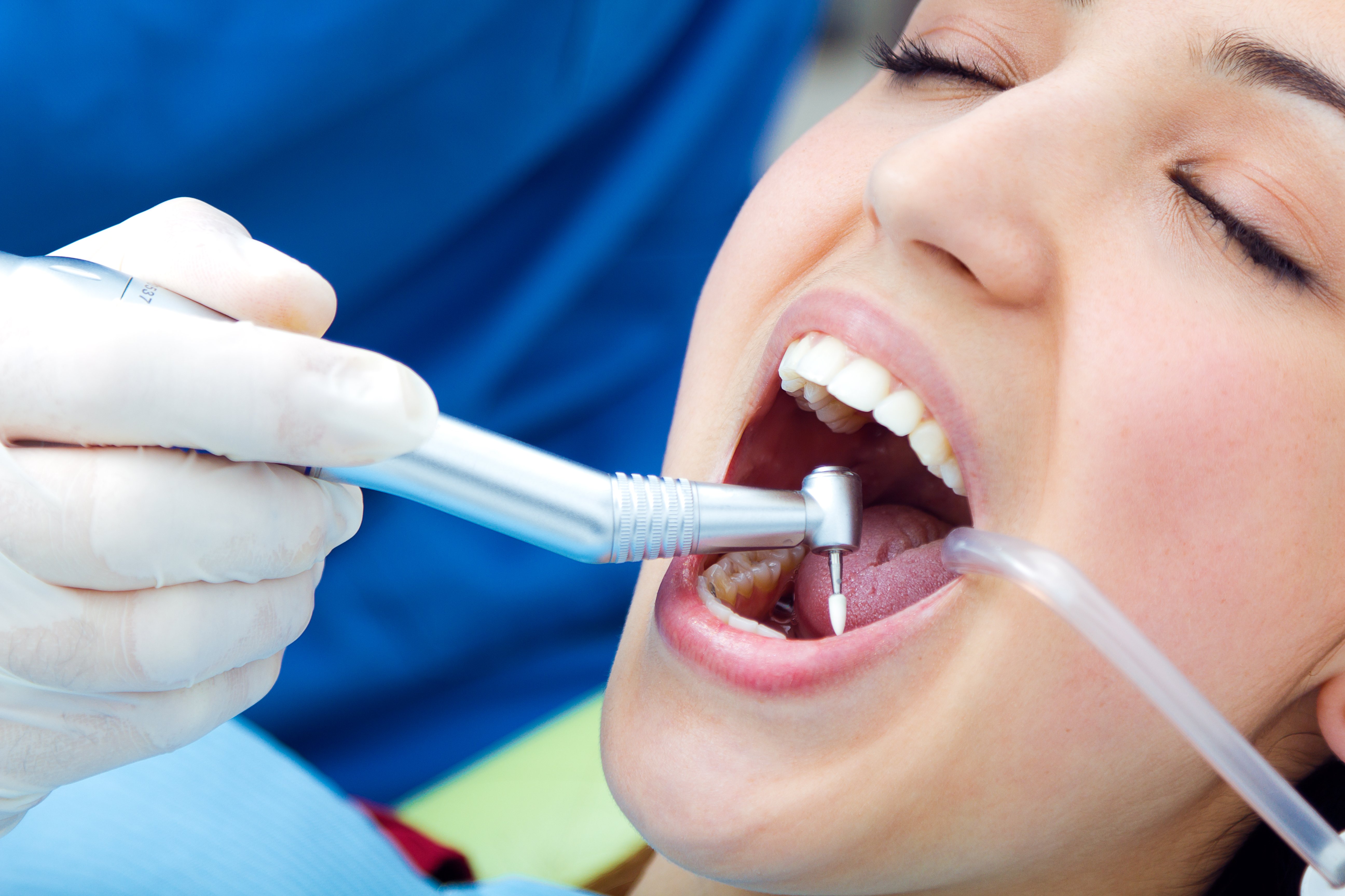 Tooth Coloured Fillings Leicester Tooth coloured dental filling treatment in Leicester