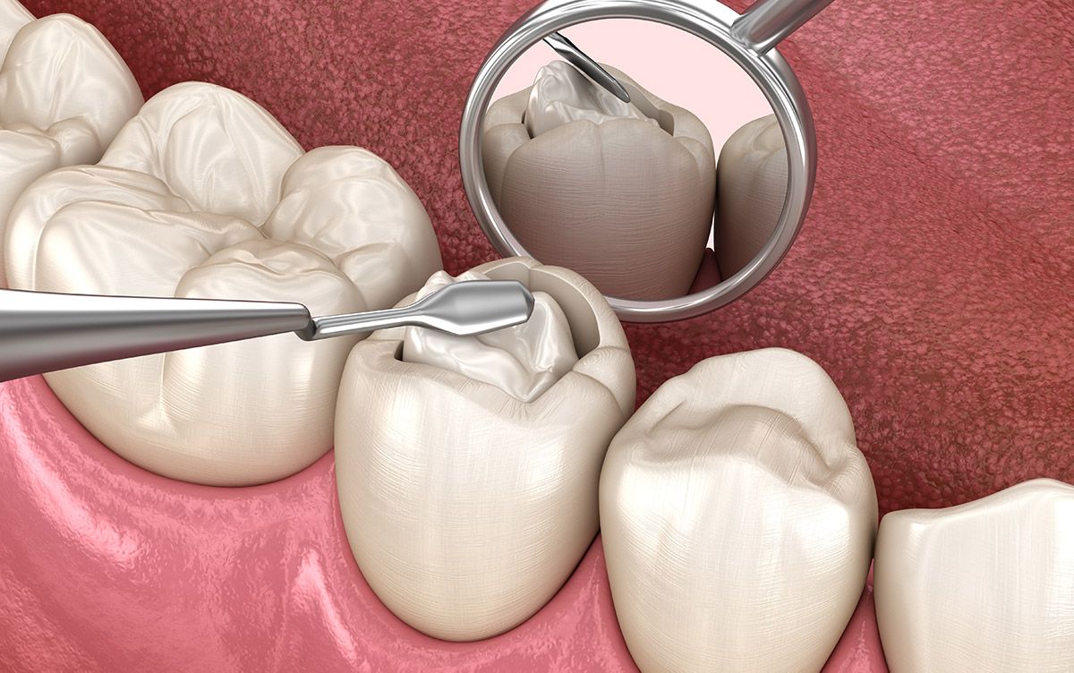 Dental Fillings Leicester Dental fillings in Leicester at Dentist 111