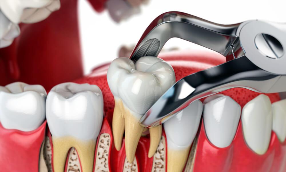 Tooth Extraction Leicester Safe tooth extraction in Leicester at Dentist 111